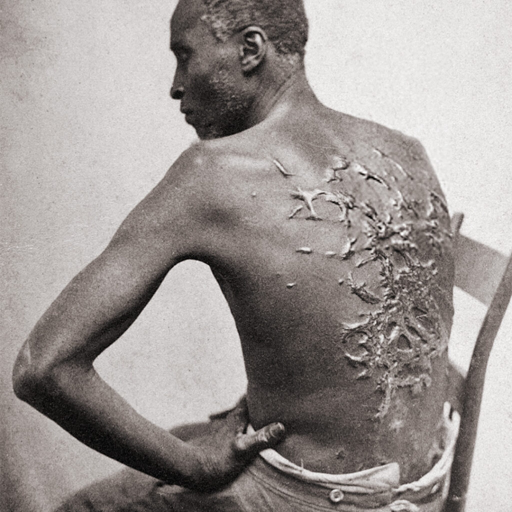 Scars from flogging on an enslaved man, Louisiana, 1863